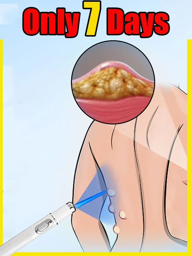 

Недавно модернизированная синяя лазерная указка, эксперт для здоровья кожи, инструмент для ухода за телом