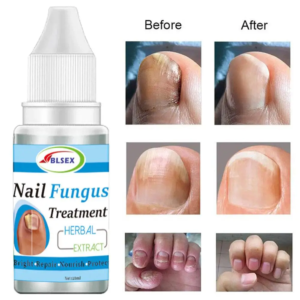 Fungus Nails Treatment for Fingernails Toenails Repair Onychomycosis Paronychia Anti Infection Toe Nail Fungal Removal Liqu A4B1