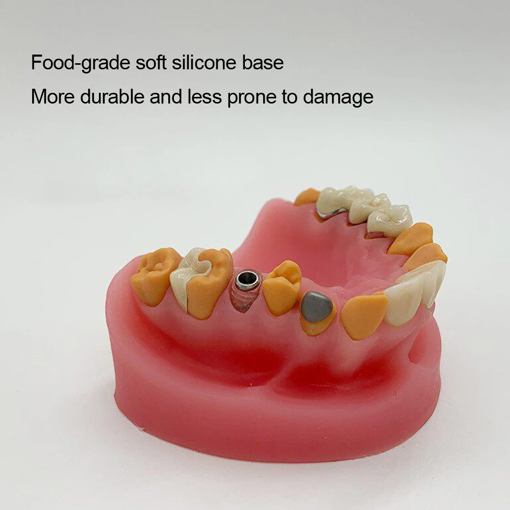 1pc High-End Dental Restorative Model Soft Gingiva Denture Model for Dentist Teaching Study