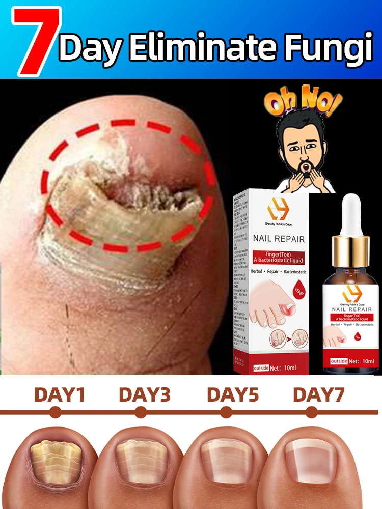 Eliminate nail fungi