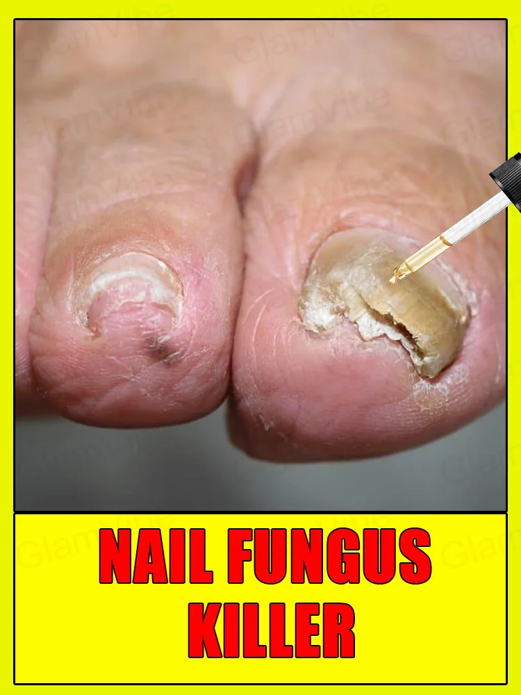 

Nᴇᴡ Oɴʏᴄʜᴏᴍʏᴄᴏsɪs Tʀᴇᴀᴛᴍᴇɴᴛ Pʟᴀɴ, Eᴀsɪʟʏ Rᴇɢᴀɪɴ Hᴇᴀʟᴛʜʏ Nᴀɪʟ Bᴇᴅs