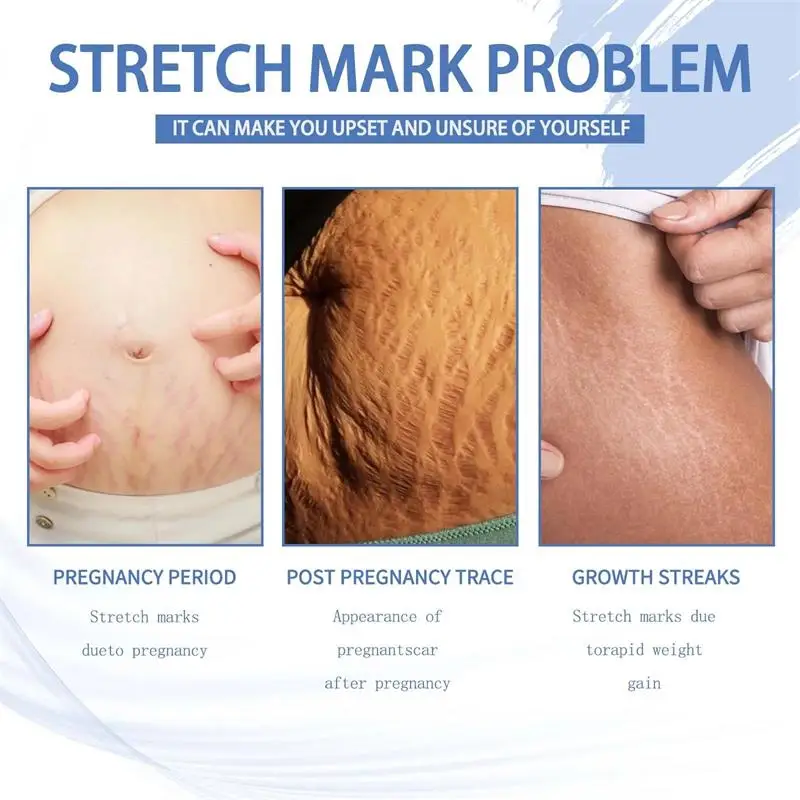 Stretch Marks Permanent Removal Cream Eliminate Body Belly Stretch Marks Swelling Marks Remove Skin Cracks Repair Firming Care