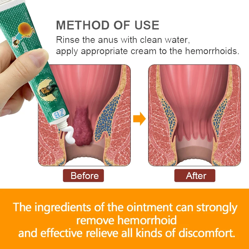 20g maści na hemoroidy sterylizują środki przeciwbólowe krem na wewnętrzne stosy zewnętrzny środek do szczeliny odbytu Hematochezia