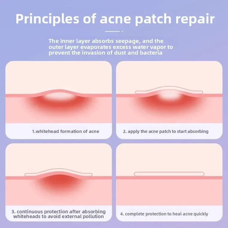 New cartoon star acne sticker, repair and anti-inflammatory acne marks, remove bean sticker, invisible acne purification and pus