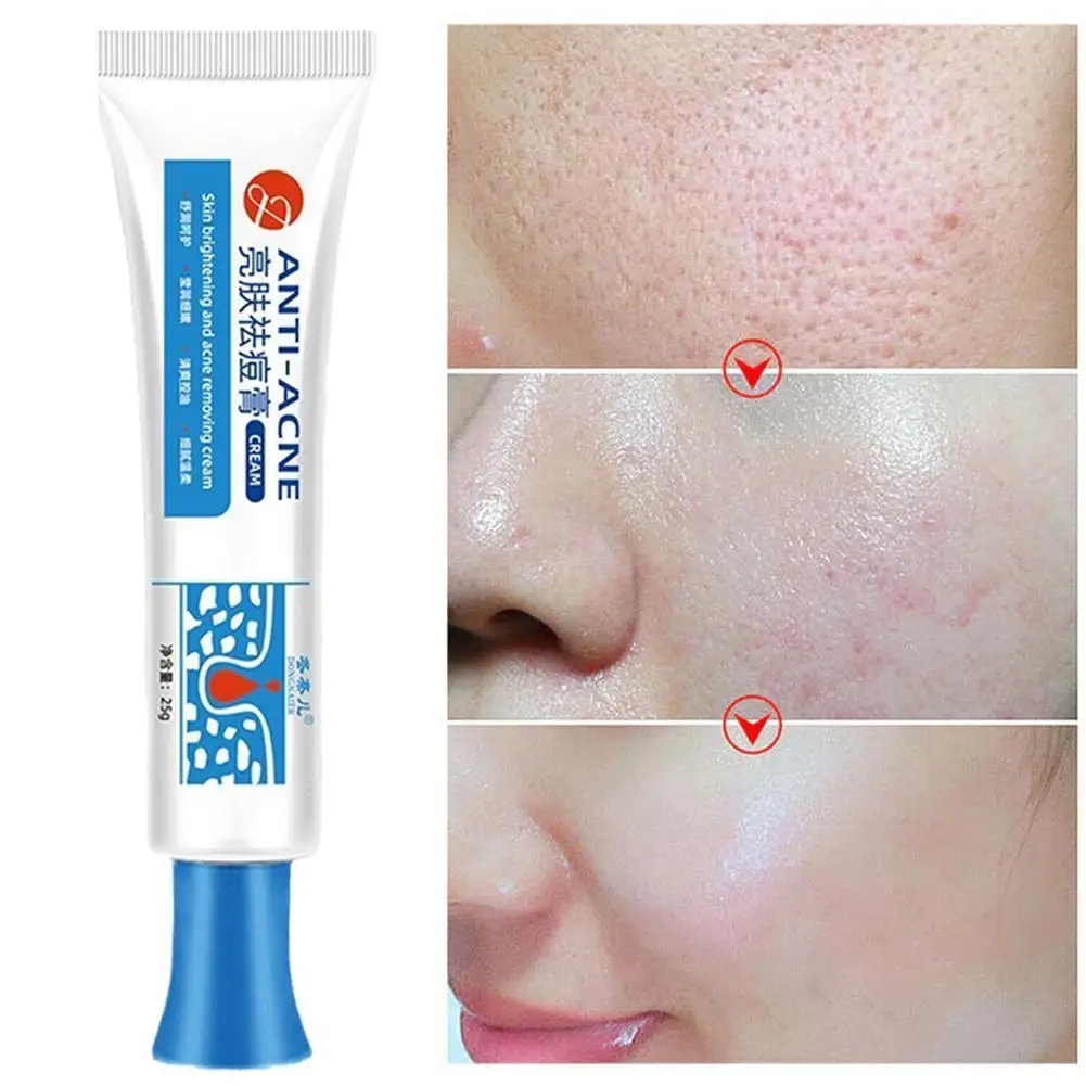 

25g Effective Acne Treatment Cream Anti Blackheads Acne Pores Brighten Beauty Skin Spots Care Smooth Products Shrink