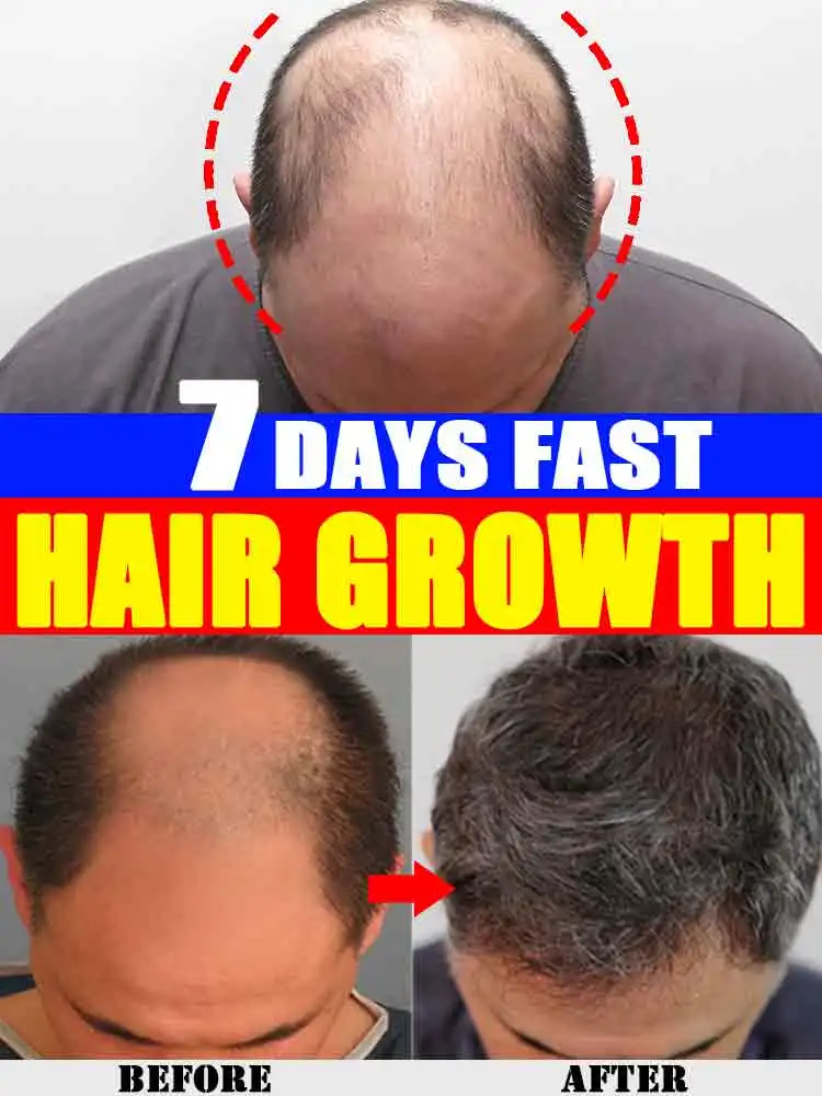 

Hair Growth Oil Fast Hair Regrowth Anti Hair Loss Products