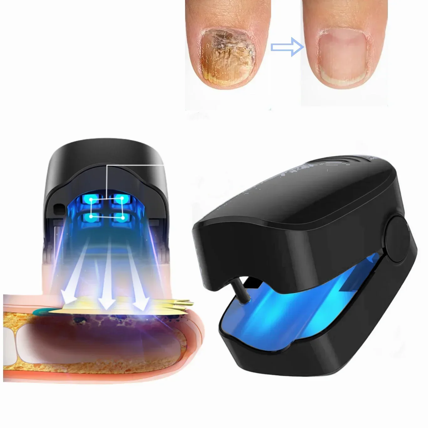 Nail Fungus Treatment Led Laser Device For Cleaning Onychomycosis USB Charge 905nm Infrared Light 470nm Blue Light Nail Care