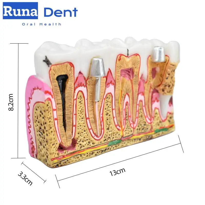 Dental Anatomy Caries Oral Model Comprehensive Pathology Tooth Nerve Tooth Model for Oral Teaching Teeth Tool