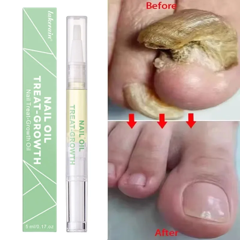 

Fungal Nail Treatment Serum Nails Fungus Removal Treating Paronychia Liquid Anti Gray Nails Toe Infection Foot Repair Care Tools