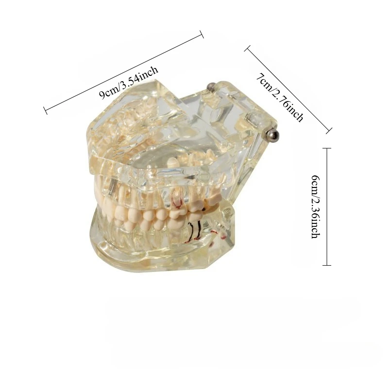Dental Implant Bridge Model, Transparent And Detachable Dental Restoration Simulation, Used For Dental Training To Assist Learni