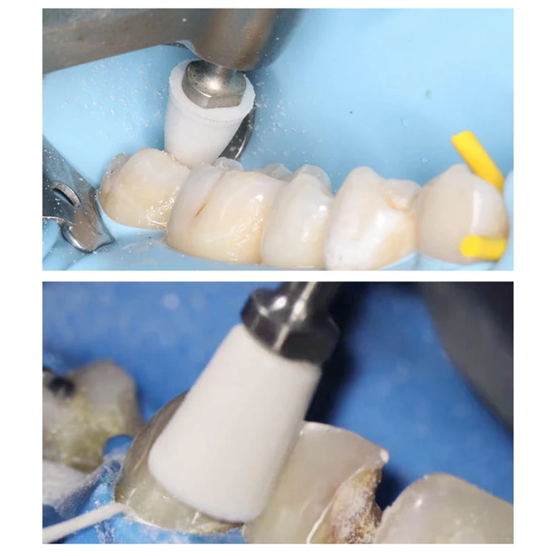 25 Stück Dental-Silikon-Ionen-Polierköpfe für Komposit-Harz, Ein-Schritt-Finishing-System, Polierkappen, Spitzen, Scheiben, RA-Dorn für Zahnärzte – Detail 5