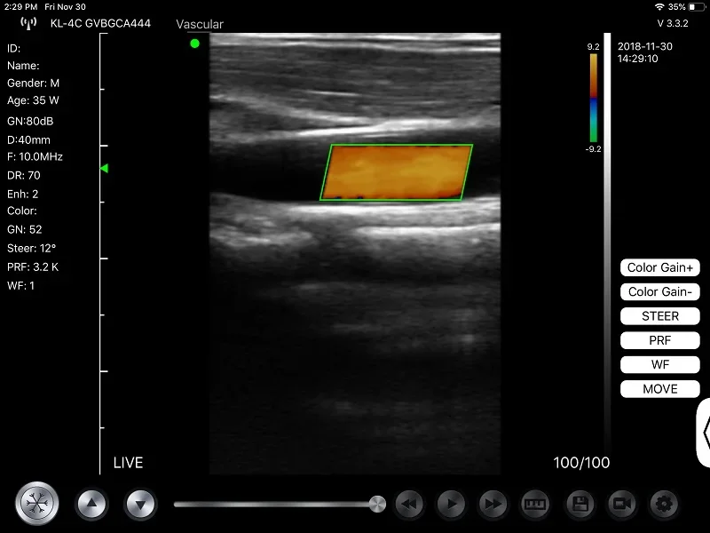 192 elements wifi easi scan high frequency 10-14Mhz linear wireless portable 4d colour ultrasound scanner with a probe