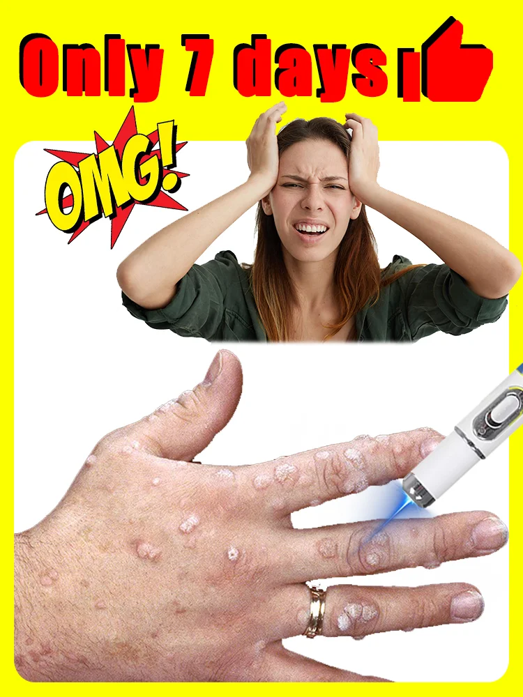 

2025 New,blue light pen solve warts,hotsale wart care tools,free shipping,home use