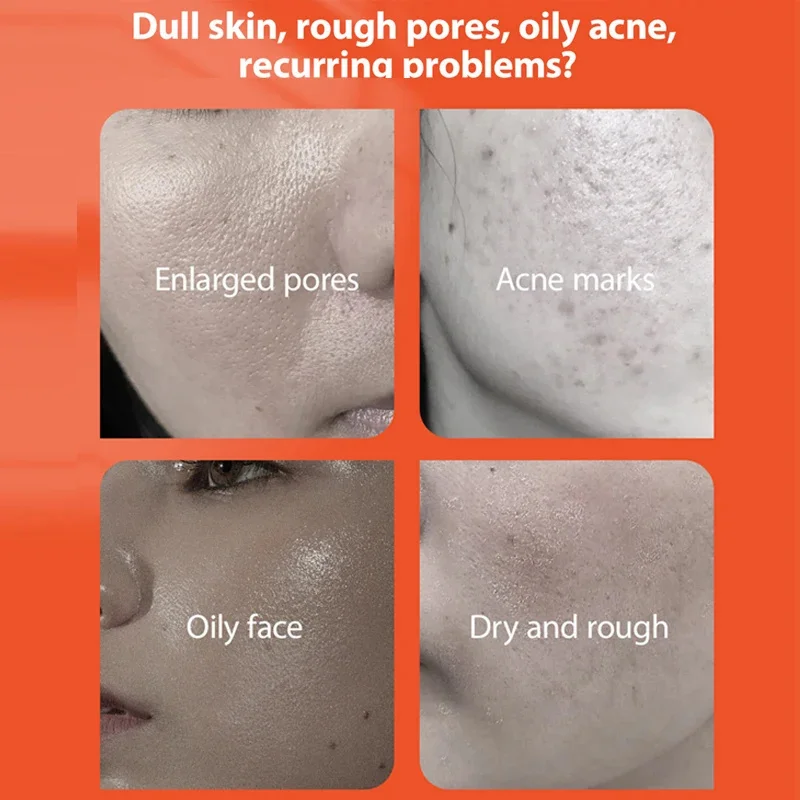 Herbal Acne Removal Face Cream Anti-Acne Gel Treatment Acne Scar Pore Shrinking Eliminate Large Pores Pimples Whitening Care