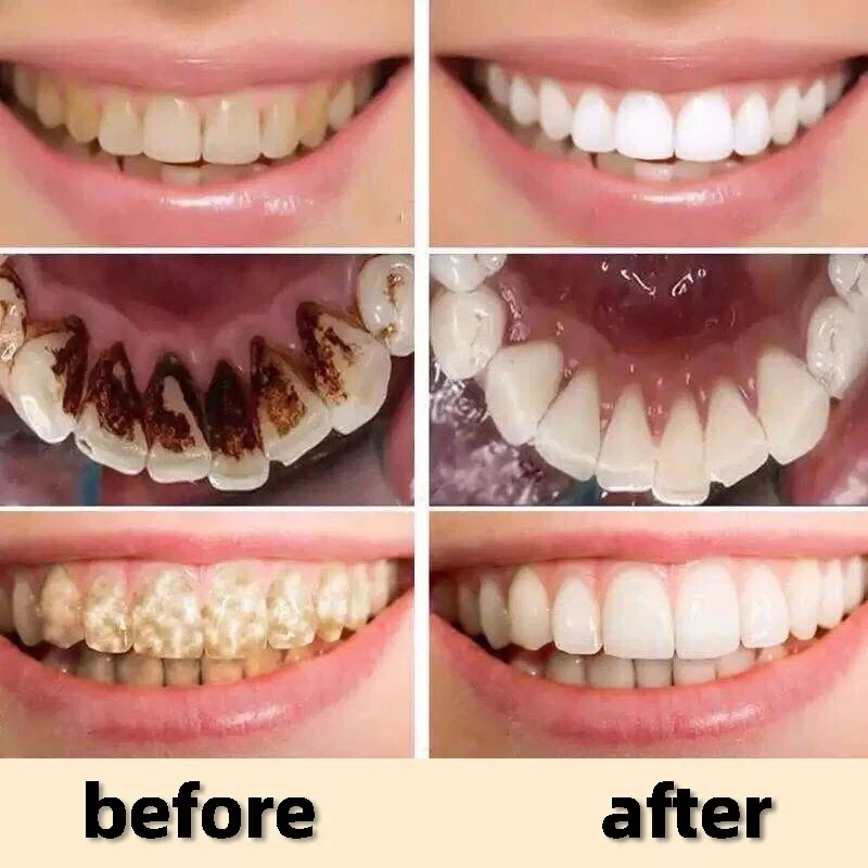 Remover Dental Calculus Remove Yellow Teeth Mouth Odor Removal Bad Breath Preventing Periodontitis Cleansing Care Toothpaste