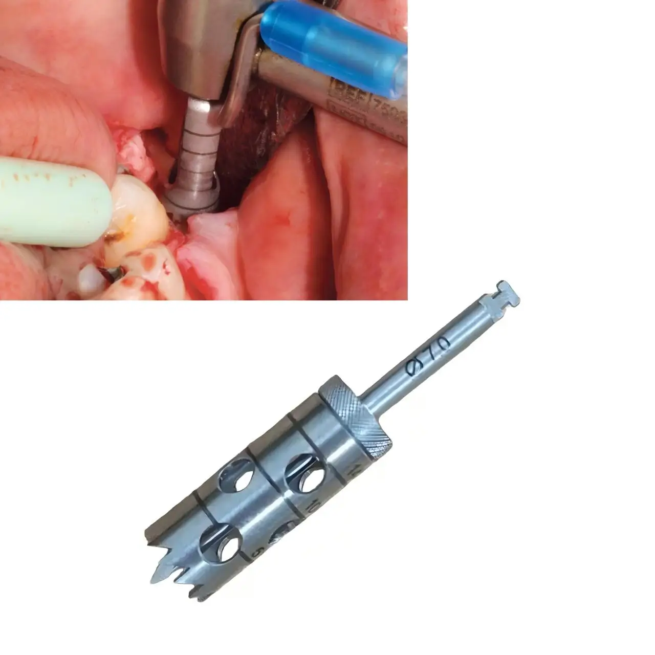 Premium Dental Trephine Drill Bit Set Stainless Steel Bone Core Harvesting Bur for Implant Surgery and Autogenous Bone Grafting