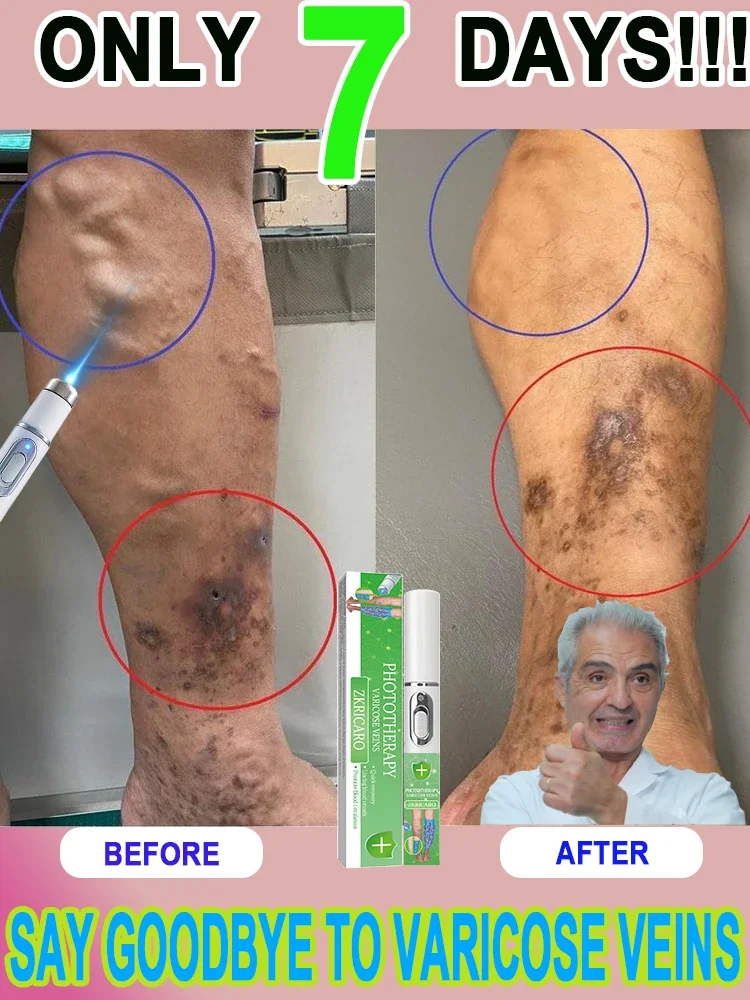 

Get rid of varicose veins and enjoy a healthy life!