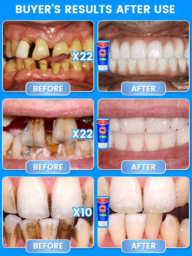 Nettoyer la cathode, filtrer les dents, enlever la plaque, traiter la parodontite, rafraîchir temporairement et laisser toute la famille avoir de bonnes dents