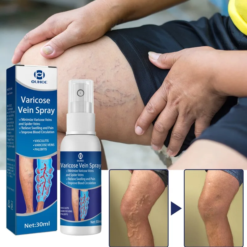 30ml Varicose Vein Spray Vasculitis Phlebitis Relief Cream Spider Legs Treatment Smoothing Blood Vessel Redness Herbal Body Care