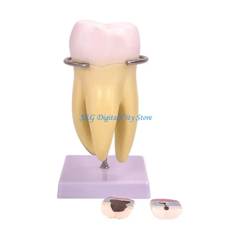 U75B Dental Anatomy Model Molar Tooth Anatomy Model with Detachable Parts Human Tooth Model for Dental Diseases Study