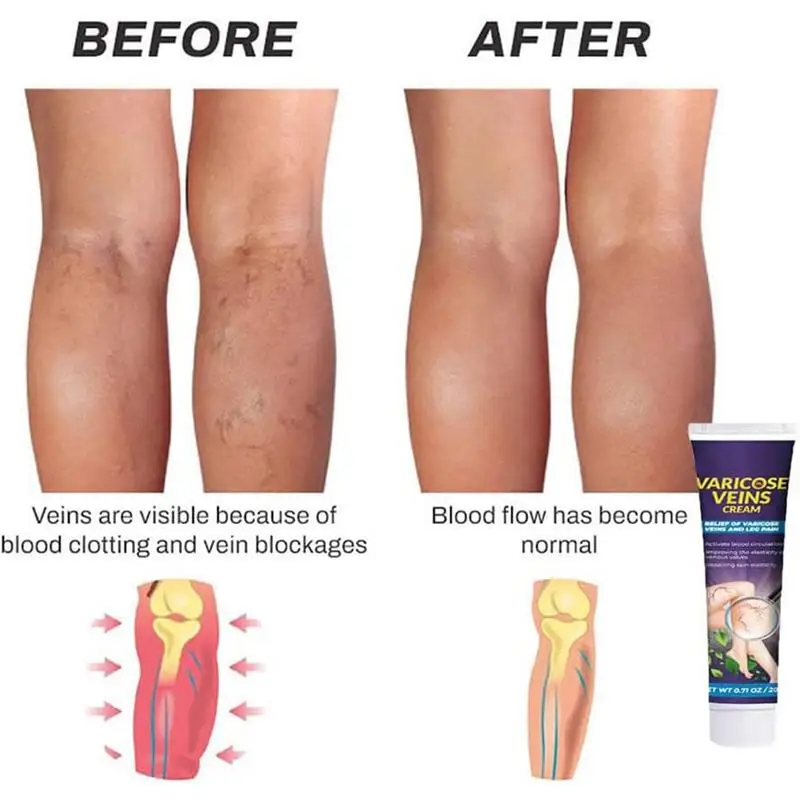 20g Varicose Vein Cream Herbal Angiitis Remedy Ointment Relief Veins Hurt Phlebitis Legs Varicose Vein Cream For Legs Care