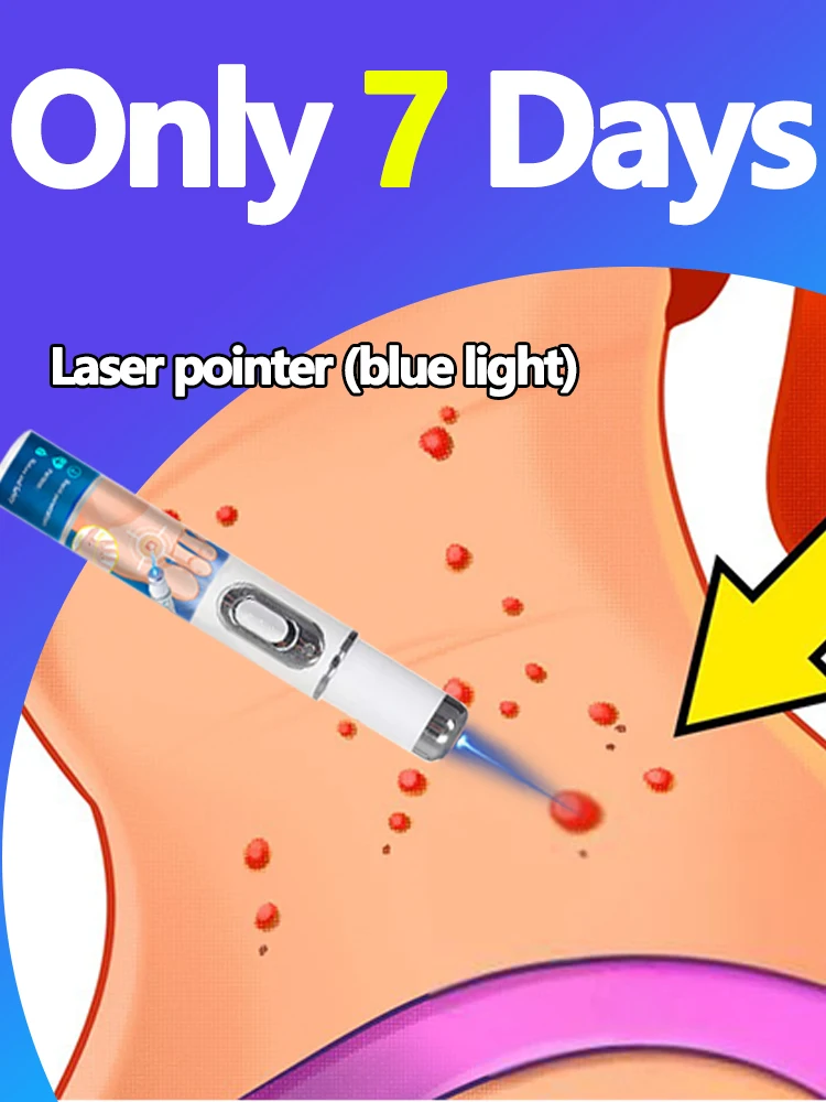 

Foot care tool. Blue light lamp for various warts. Cleaning tool.