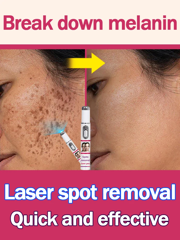 

laser repair spots hot sale