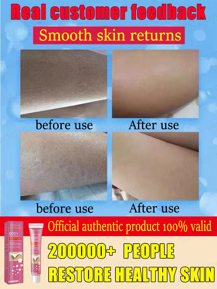 โลชั่นทาตัว Keratosis Pilaris ครีมสตรอเบอรี่กำจัดสิวเสี้ยน