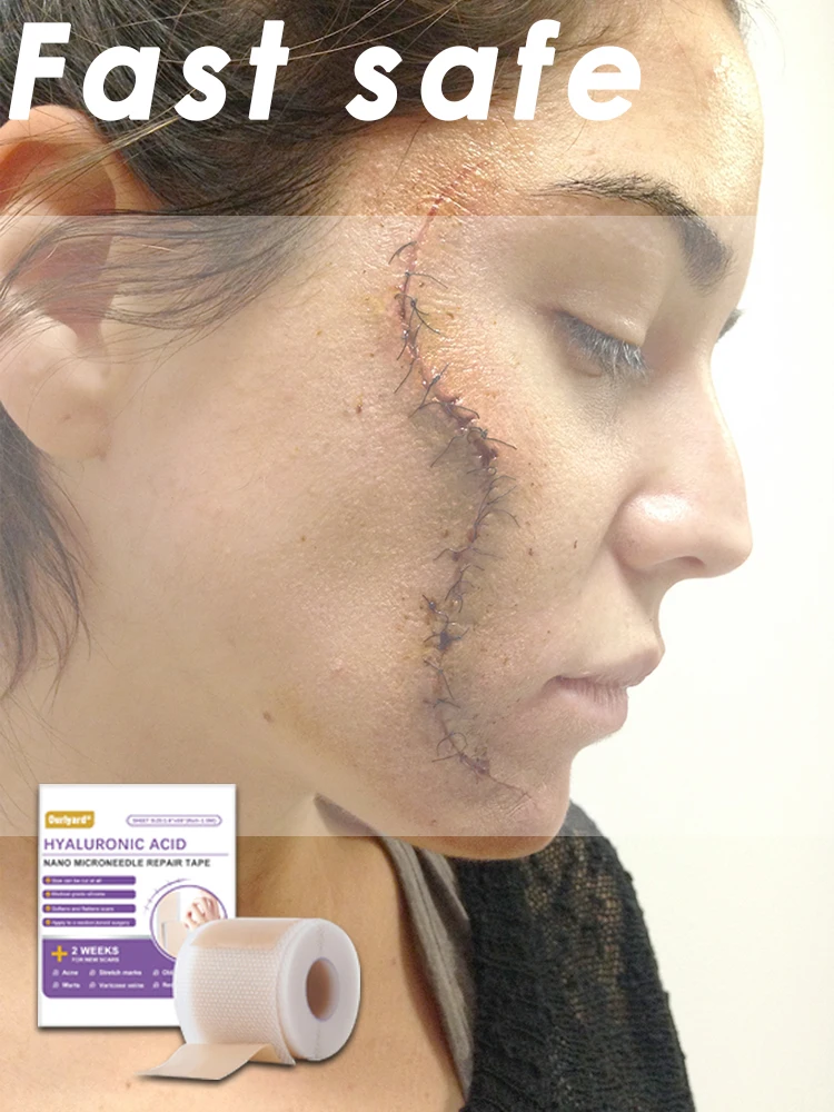 

1 Roll Silicone Scar Sheets , 4cmX150cm Self-Adhesive Scar Cover Tape Reusable and Effective Skin Care Strips