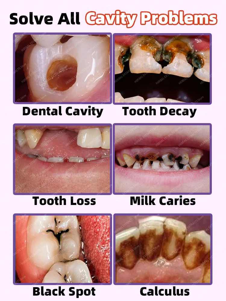 Decay tooth Cavities healing anti caries