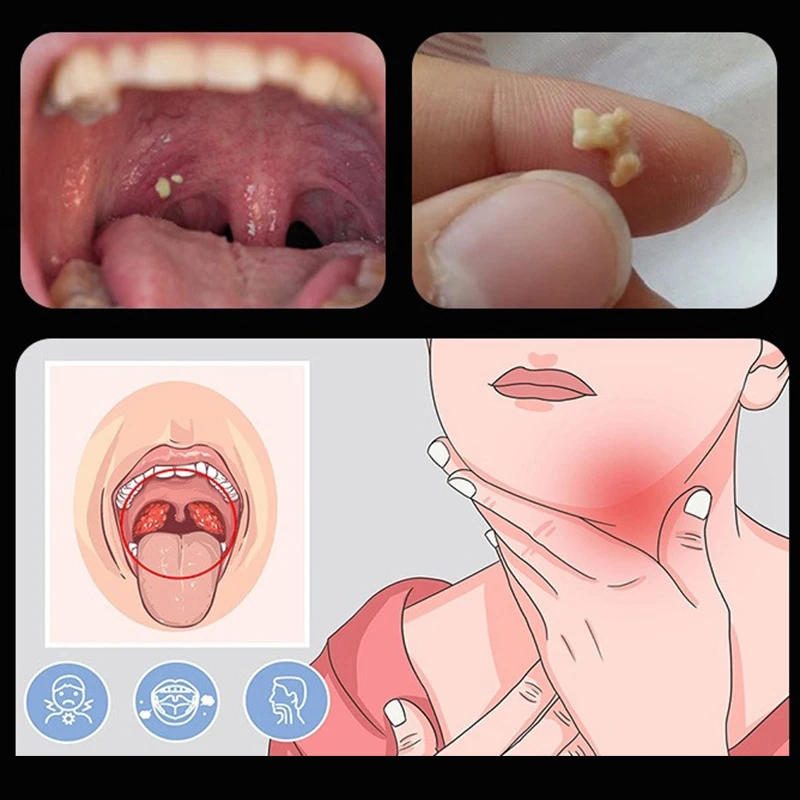 ~Ear Wax Tonsil Stone Remover Tool LED Light Stainless Steel Remover Mouth Cleaning Care Tools.