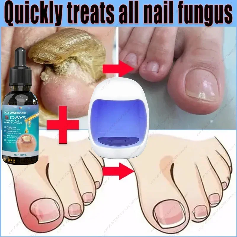 About, laser cure for onychomycosis, nail art for life, equipment for curing onychomycosis and onychomycosis