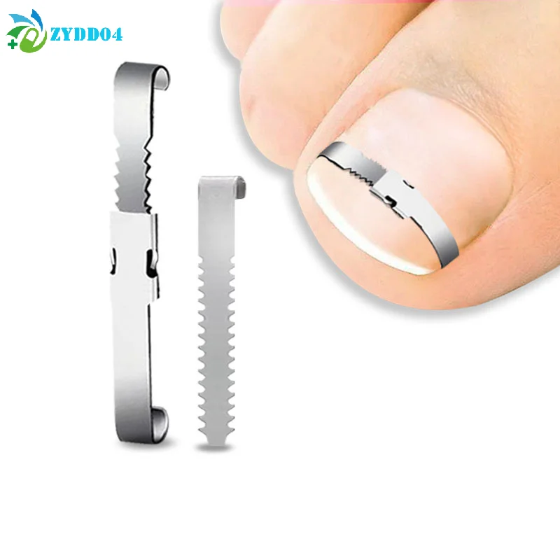●Ingrown Toenail Co…