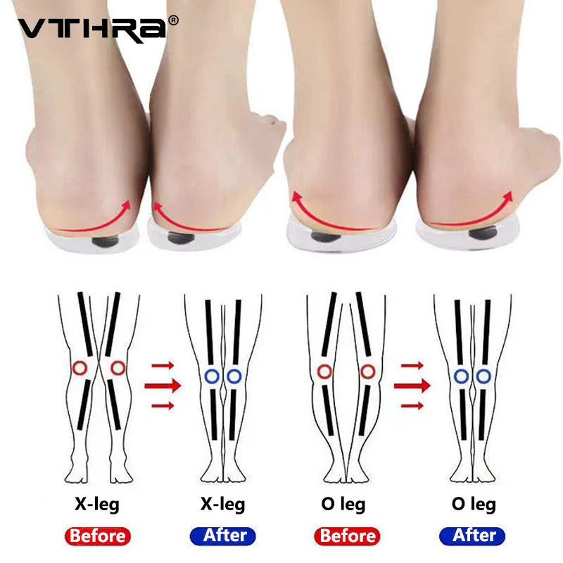 1 Pair Magnet Silicon Orthopedic Insole Foot Care Pad Tool For Men Women Health Care O/X Type Leg Knee Varus Correction Heel Pad