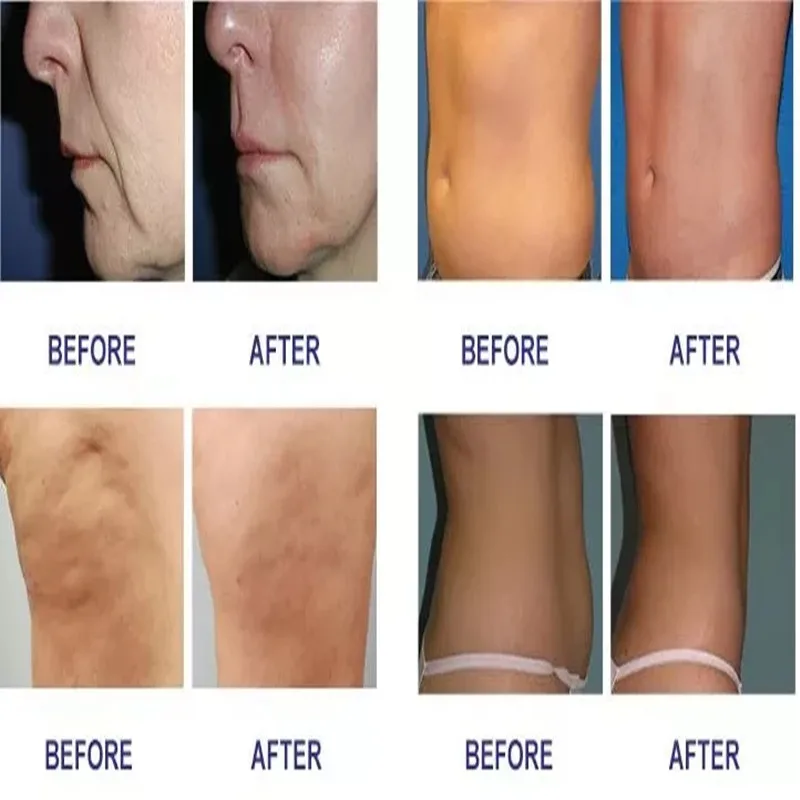 Inteligente Multifuncional Bd Lift, Não-invasivo Shaping Lifting, Levantamento e remoção de linhas finas, 2024, Produto mais recente