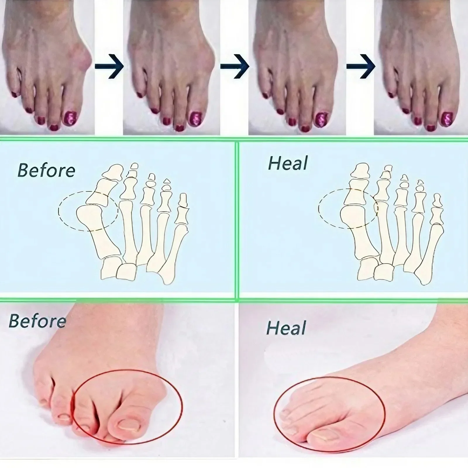 STONEGO Silicone Hallux Valgus Corrector Toe Separators Bunion Correctors Foot Finger Splitter Orthotic Device for Foot Bone