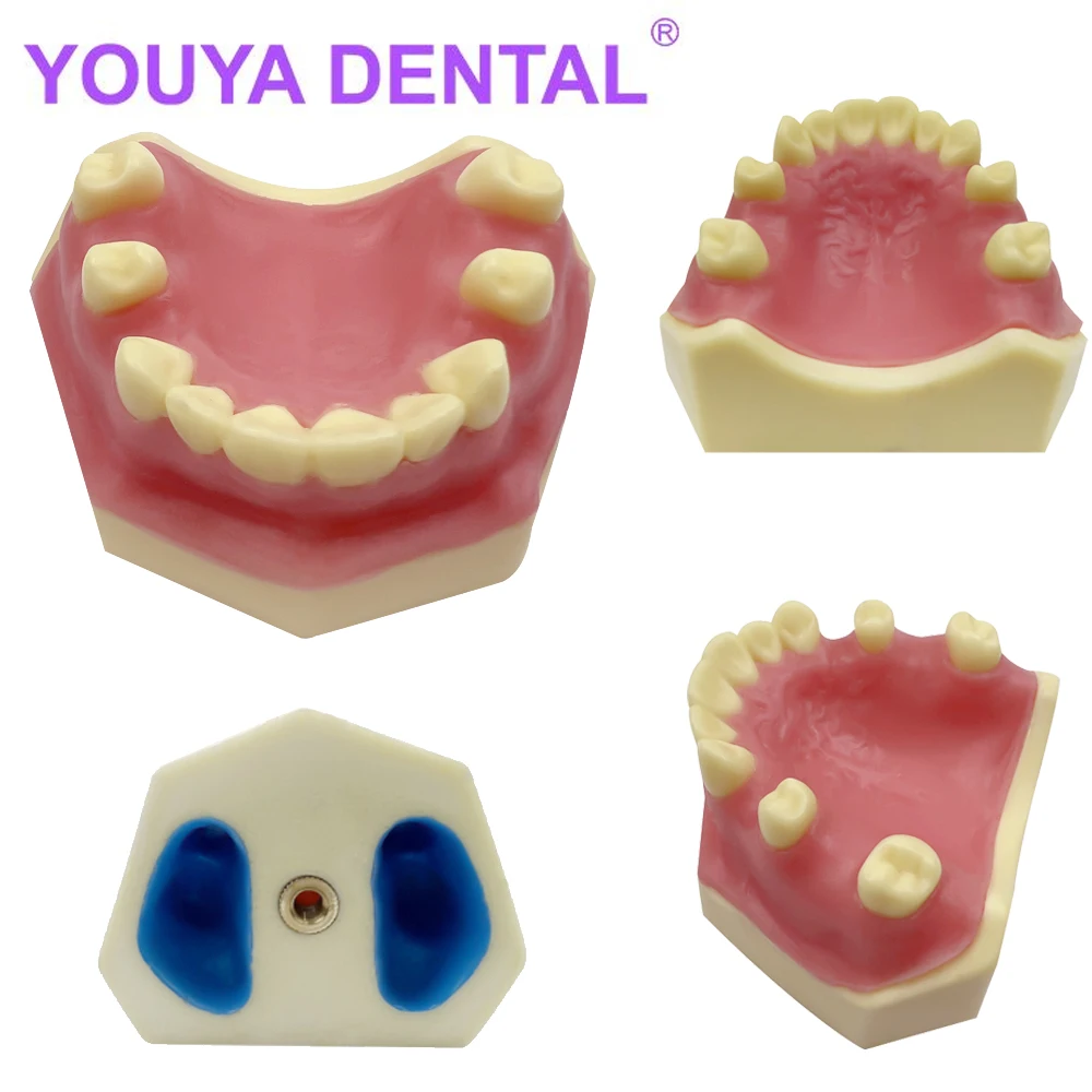 

Dental Teeth Model for Implant Analysis Dentist Student Studying Teaching Models Dentistry Practice Typodont Demonstration Tool