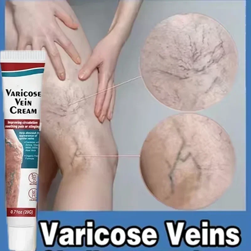 Varicose Veins Effective Relief Of Dilated Vasculitis In The Legs Phlebitis Improved Blood Circulation