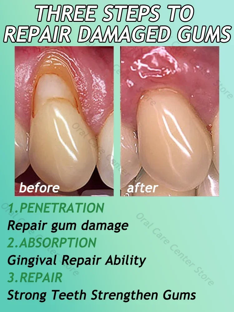 Effectively repair damaged gums, relieve toothache, strengthen teeth and strengthen gums