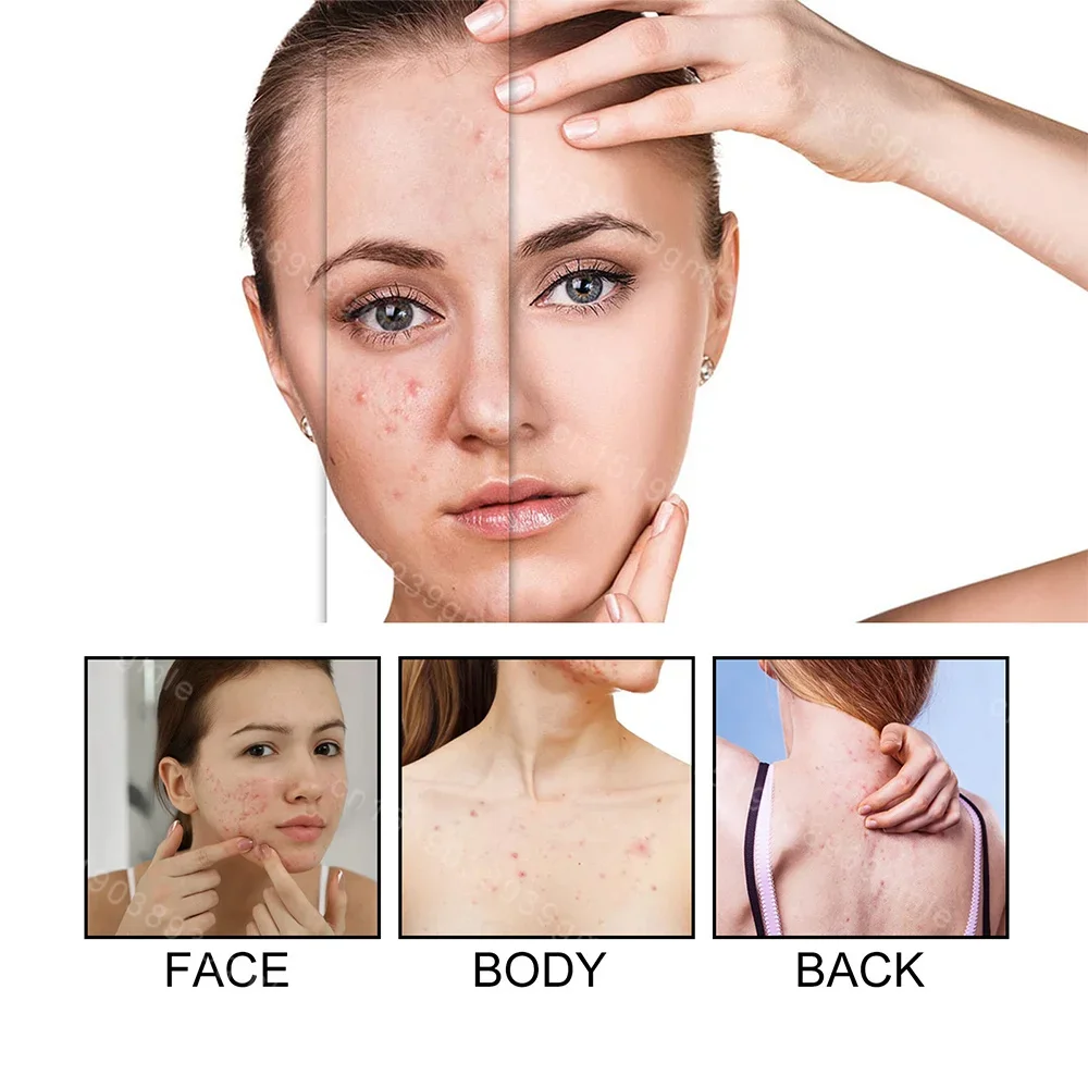 Star Acne Patch Dissolvenza Riparazione Adesivi invisibili per la rimozione dell'acne Simpatico correttore Strumento per il trucco Stile stella con scatola di immagazzinaggio a specchio