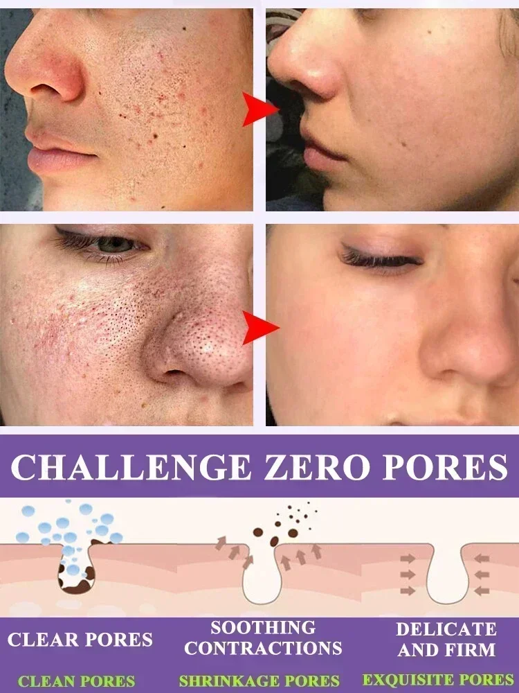 Acidez Poro Encolher Soro Rosto, Remover Cravos, Acne, Controle de Óleo, Reparação Essência, Hidratante, Nutrir Poros Refirmando, Cuidado Facial