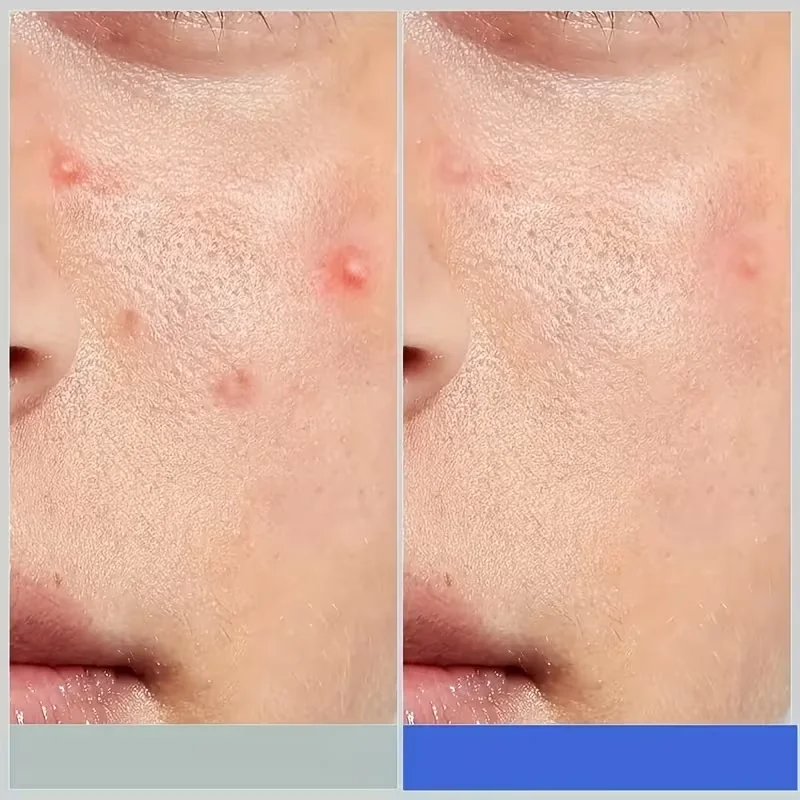 180+12 قطعة/علبة من رقع حب الشباب - غير كحولي، تستخدم لامتصاص أقلام حب الشباب، غير مزعجة، أساسية للعناية بحب الشباب