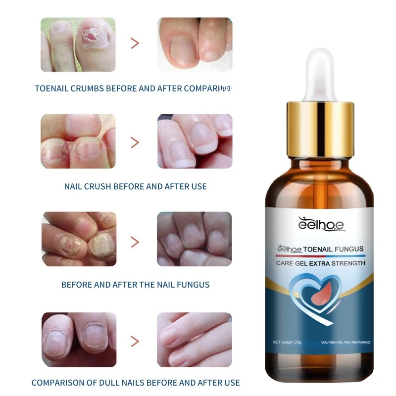 Toenail Fungus repair essence Treatment onychomycosis hand feet fungal Anti-infective Paronychia soft nails thickening nail Gel