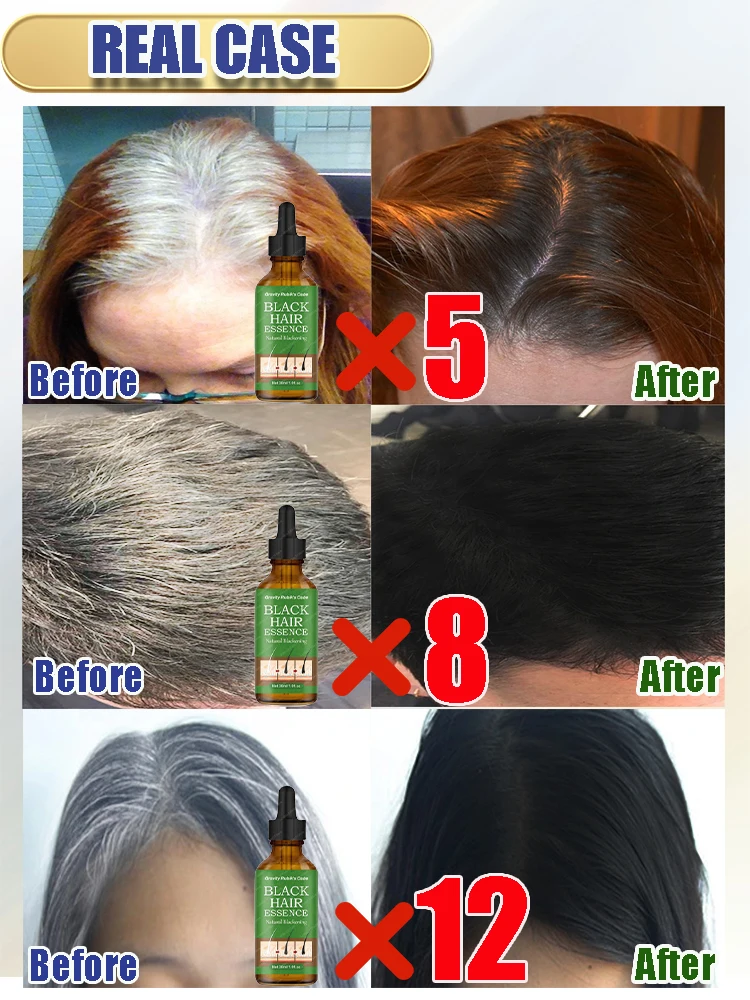 Anti Gray Hair Serum Gray Hair Treatment Remedy White Darkening Products