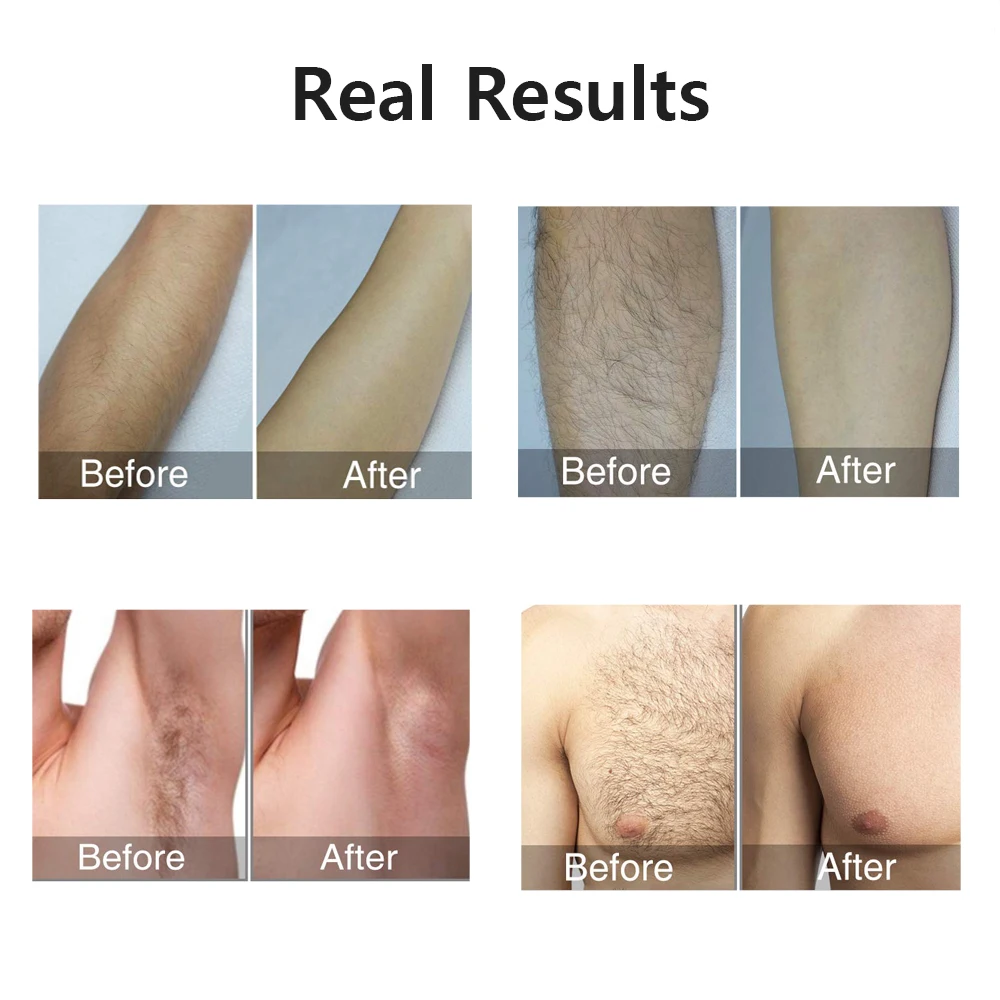 Laser Epilator IPL Hair Removal For Women Body Bikini Facial 990000 Flashes Permanant Painless IPL Hair Remover Laser Epilator