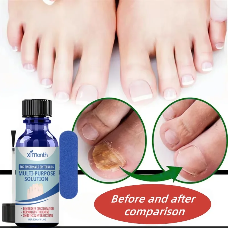 7days Nagel Pilz Behandlung Serum Ingwer Anti-infektiöse Paronychie Onychomykose Kappe Fuß Nagel Pilz Reparatur Gel Hand Fuß pflege