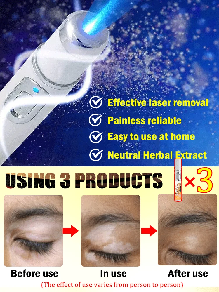 Generation-TWOND Laser Says Goodbye To Vitiligo In 7 Days - Image 4