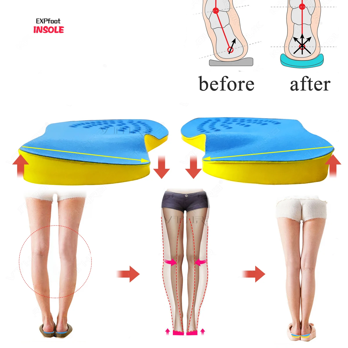 

O/X Leg Orthopedic Insoles Correction Shoes Inserts For Foot Alignment Knock Knee Pain Bow Valgus Varus Feet Care Cushions