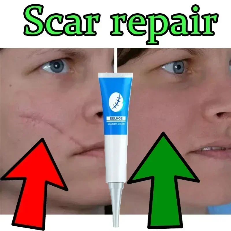 

Skin Scar Removal For Burns Surgery Plastic Surgery Hyperplasia Acne Marks Stretch Marks Pigment Skin Care0903