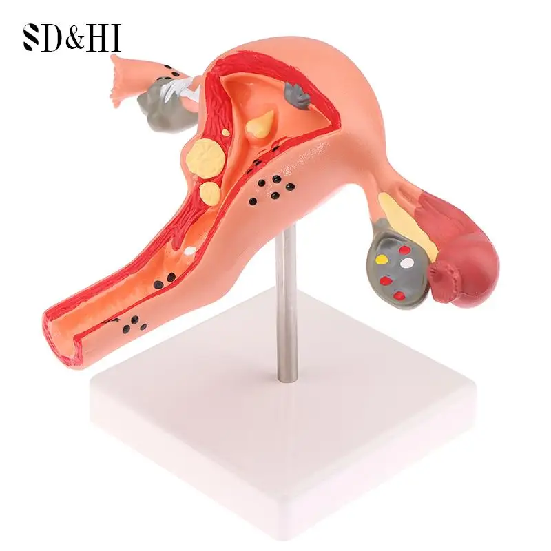 Human Pathological Uterus Ovary Model Cross Section Structure Model Uterus Anatomical Model Anatomy Female Organ Study Tool